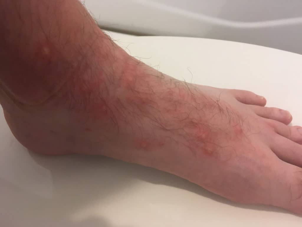 Chigger bites on a foot